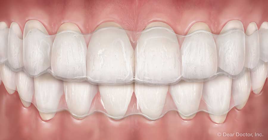 Clear Orthodontic Aligners.